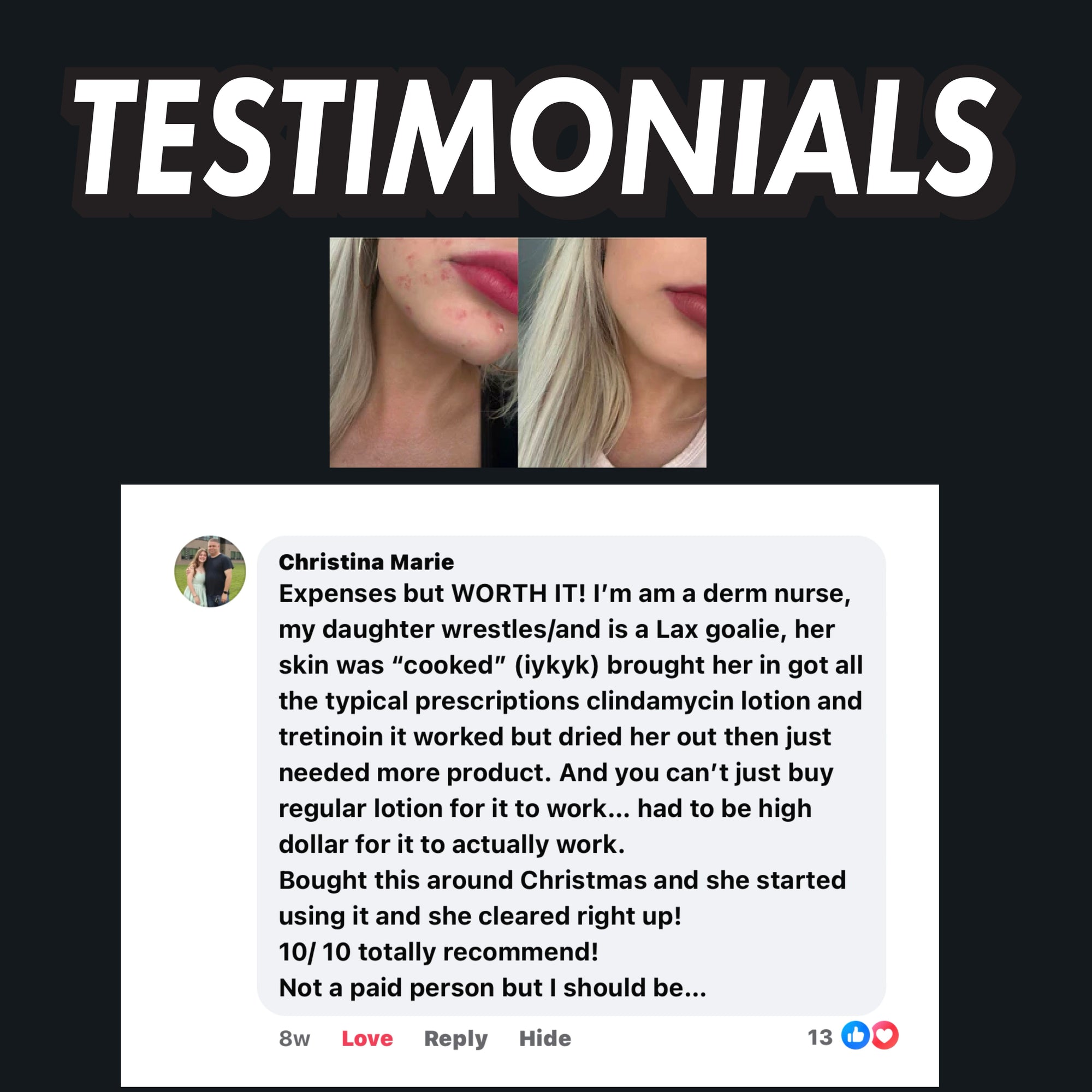 Black Diamond Face Scrub (Severe Acne)