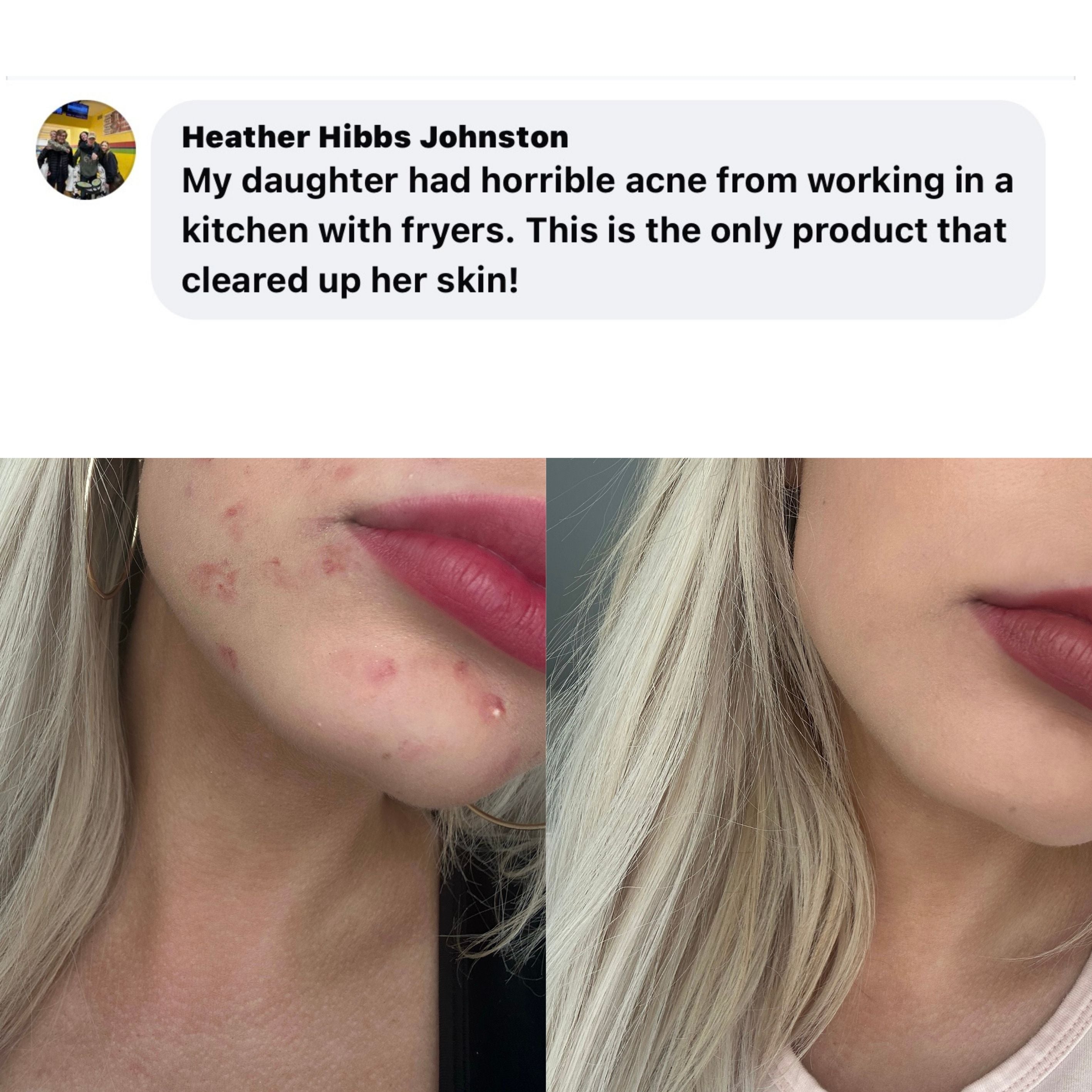 GIRLZ Full Body Acne Gameplan