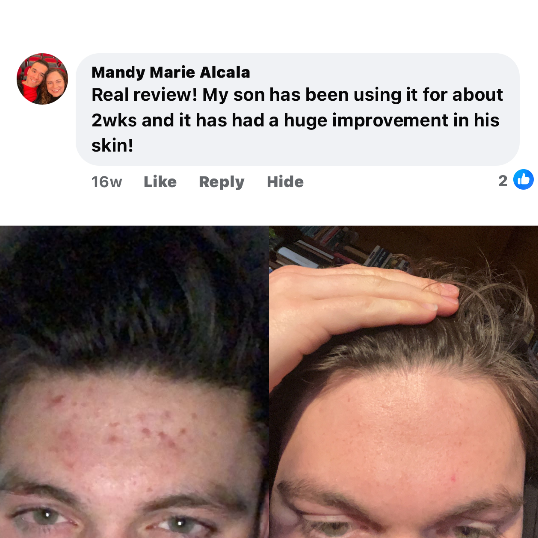 BOYZ Face Acne Gameplan (#1 Seller)