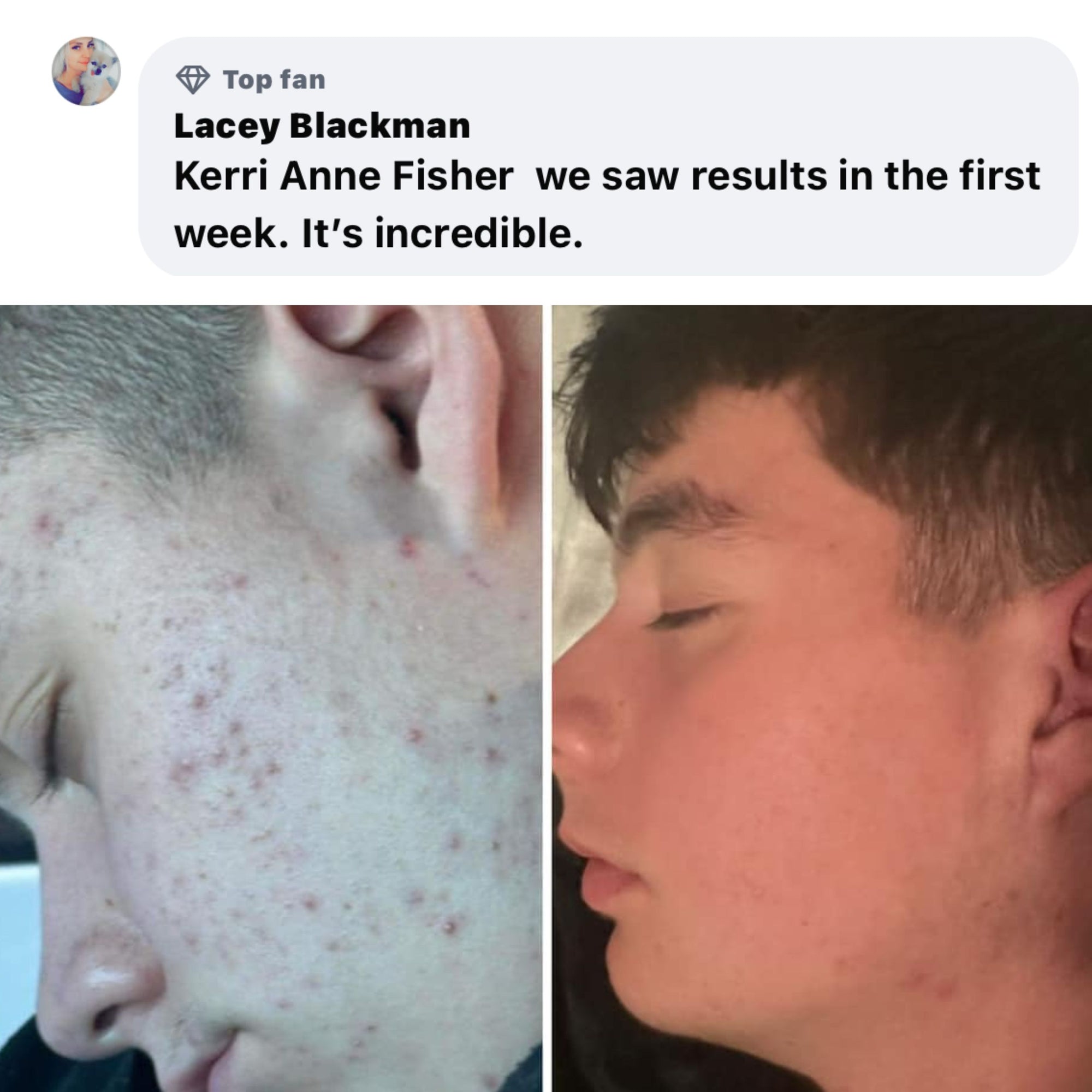 BOYZ Face Acne Gameplan (#1 Seller)