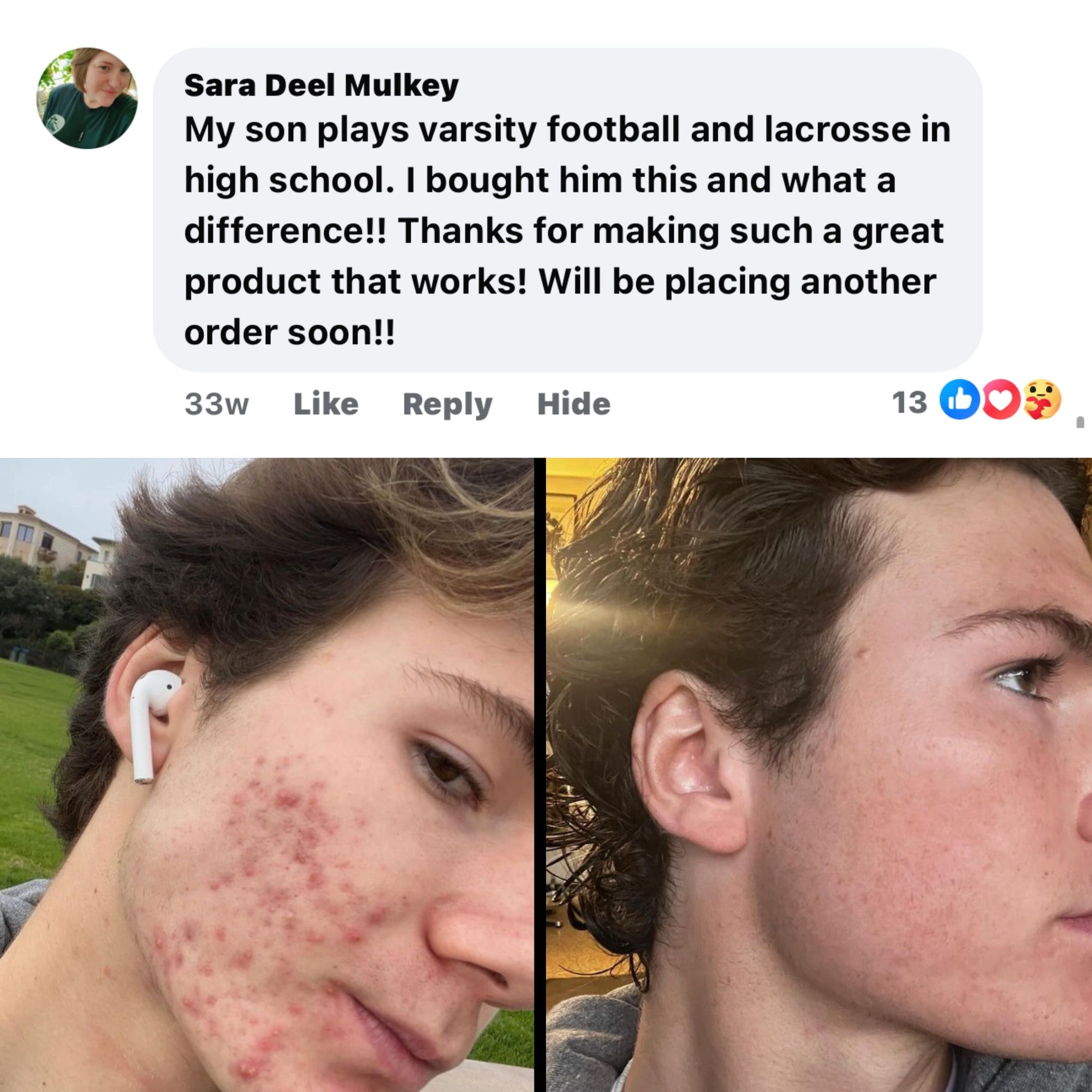 BOYZ Face Acne Gameplan (#1 Seller)