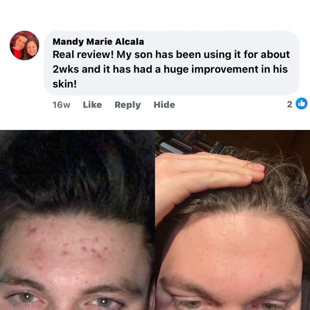 Boyz Athlete Acne Pack $29.99