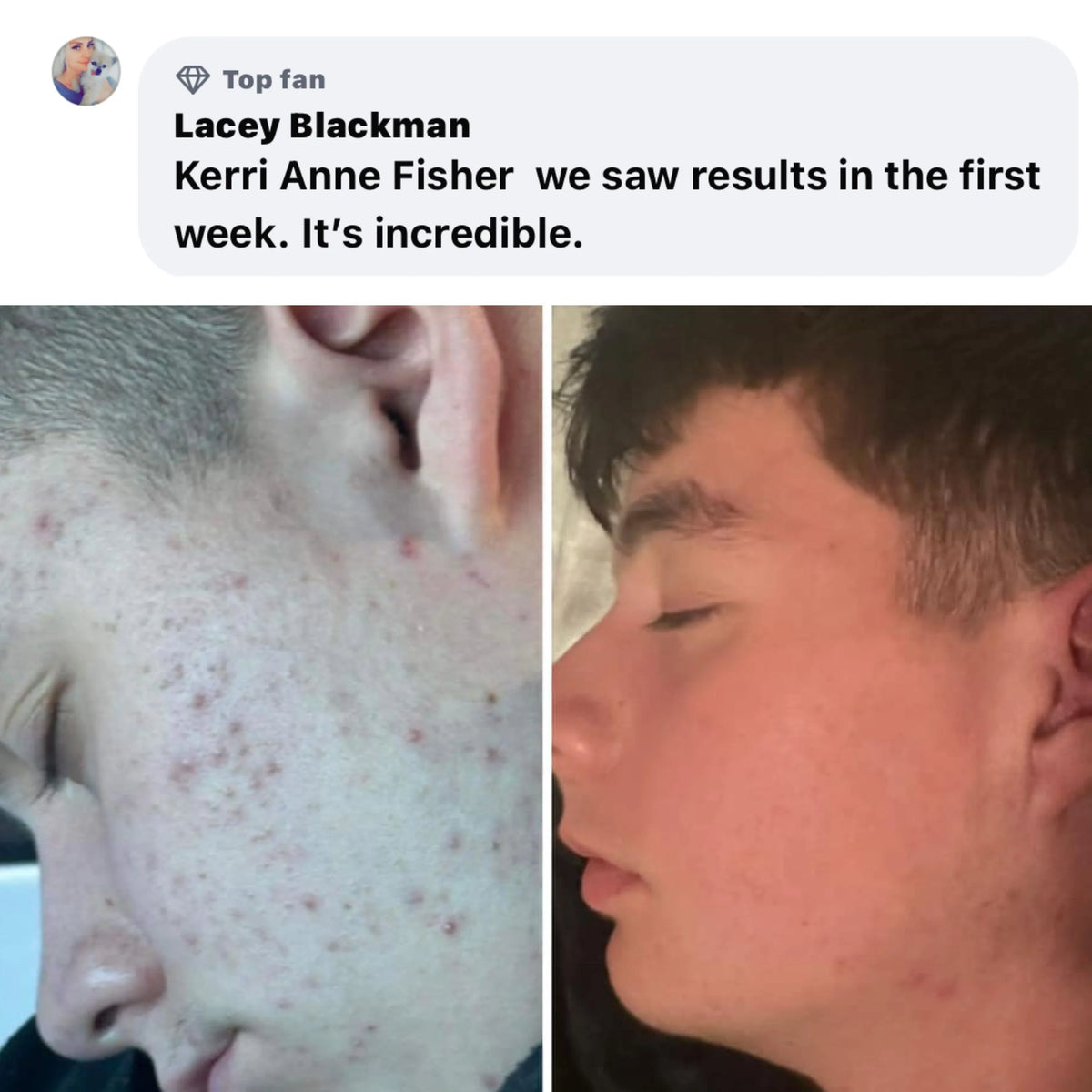 Boyz Athlete Acne Pack $29.99